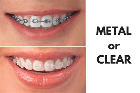 clear brackets vs metal braces